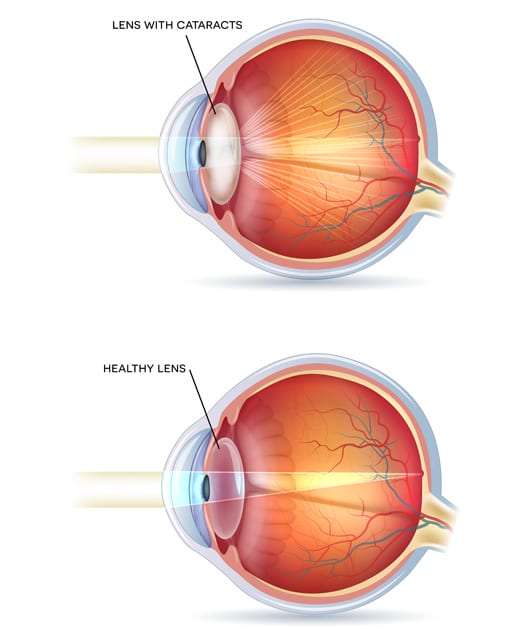 Example of a Lens with Cataracts