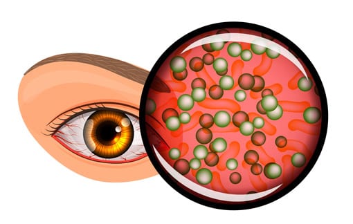 Conjunctivitis Example