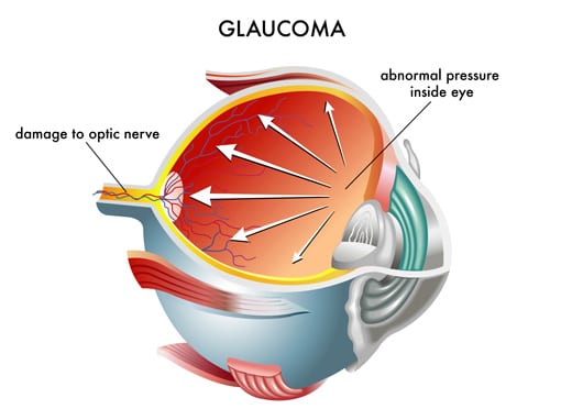 Glaucoma  Triad Eye Institute