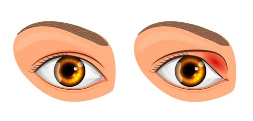 Poor Eyelid Closure (Lagophthalmos)