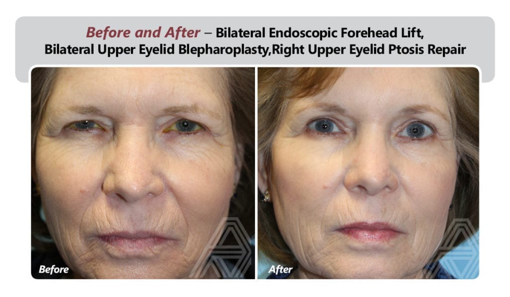 Forehead & Brow Lift | Triad Eye Institute