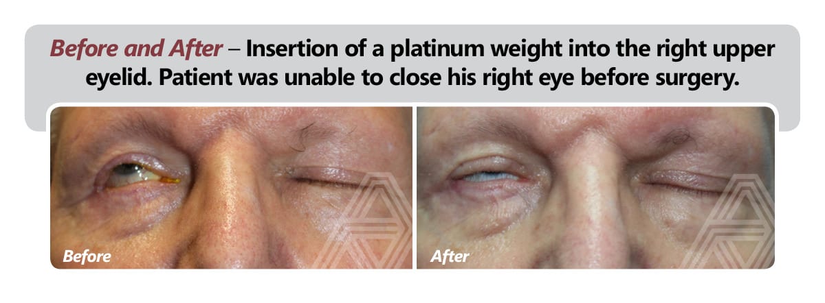 Gold or Platinum Eyelid Weight to Treat Incomplete Eye Closure in