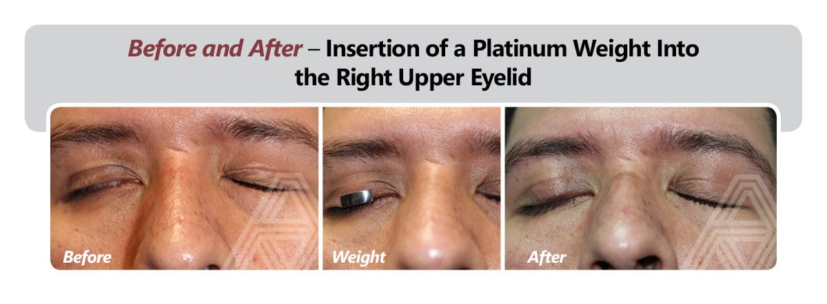 Poor Eyelid Closure Lagophthalmos Triad Eye Institute