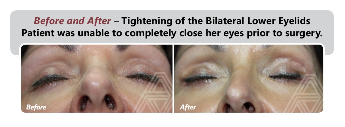 Poor Eyelid Closure Lagophthalmos Triad Eye Institute