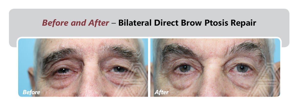 Brow Ptosis | Triad Eye Institute