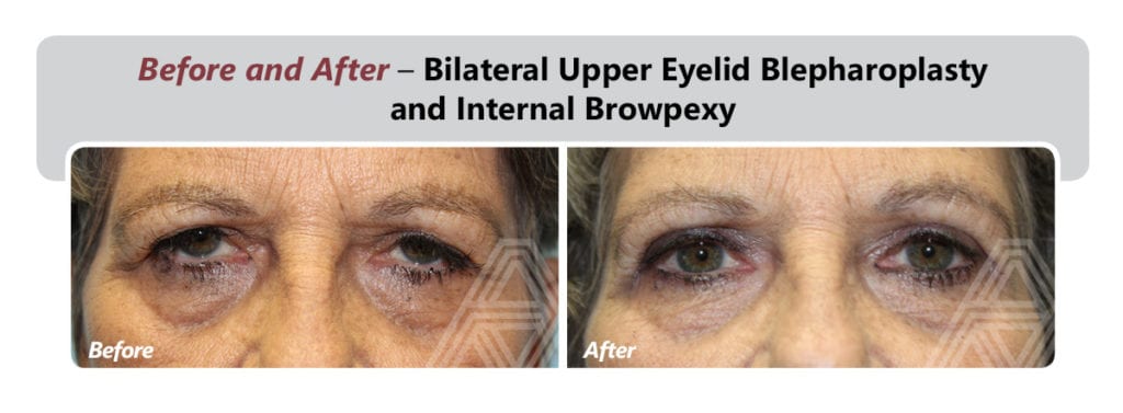 Eyelid Lift (Blepharoplasty) | Triad Eye Institute