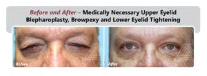 Eyelid Lift (Blepharoplasty) | Triad Eye Institute