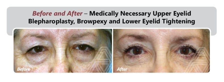 Eyelid Lift (Blepharoplasty) | Triad Eye Institute