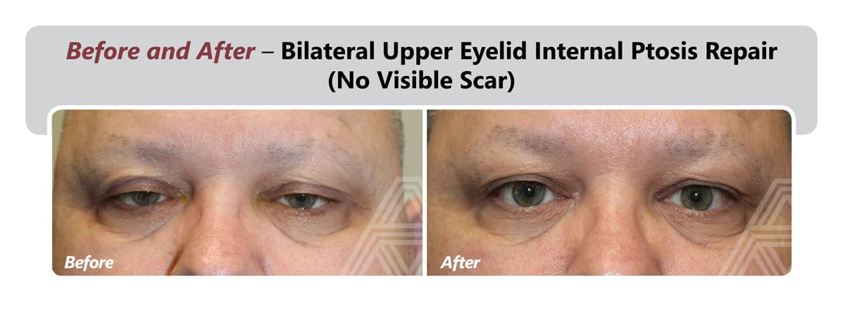 Eyelid Ptosis Repair Triad Eye Institute