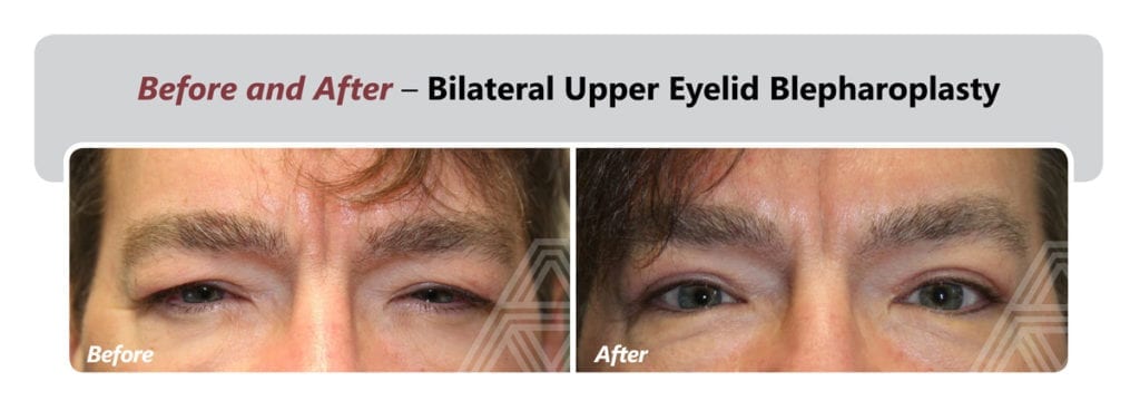 Eyelid Lift (Blepharoplasty) | Triad Eye Institute