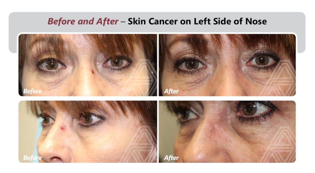 Eyelid & Facial Skin Cancer Triad Eye Institute