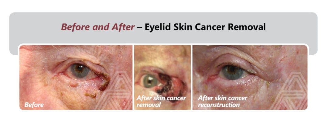 Eyelid Facial Skin Cancer Triad Eye Institute