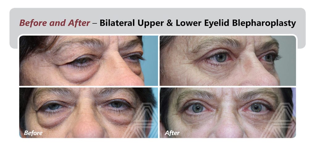 Eyelid Lift (Blepharoplasty) | Triad Eye Institute