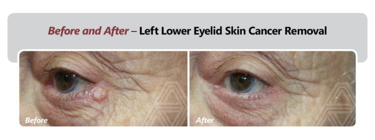 Eyelid And Facial Skin Cancer Triad Eye Institute