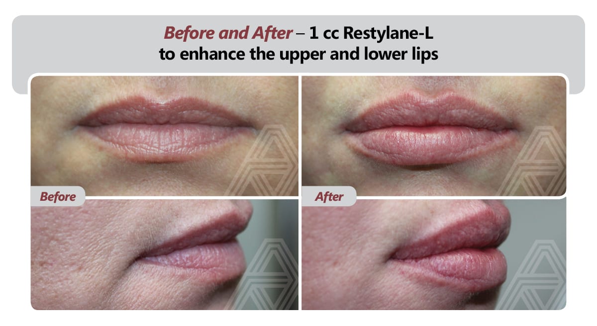 restylane-chevy-chase-maryland-wrinkle-reduction